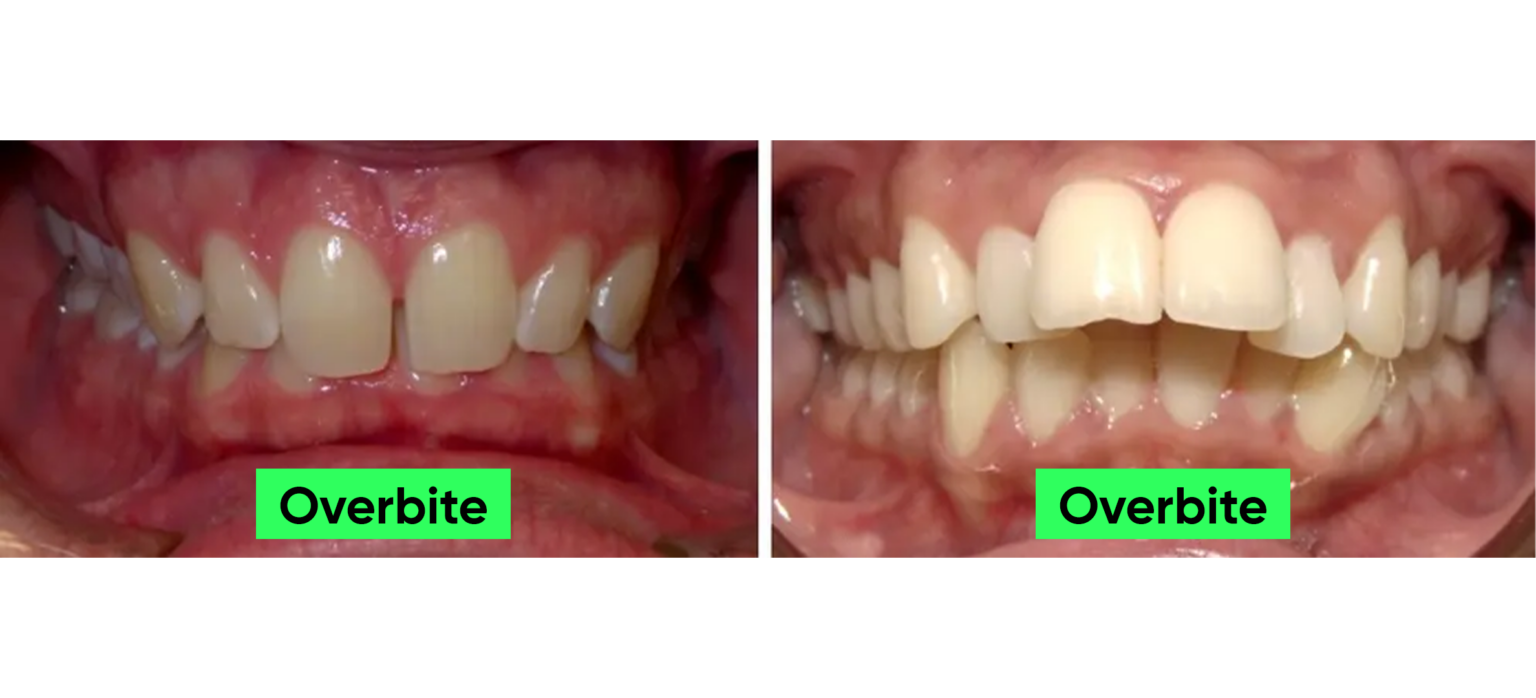 How Can Mewing Fix Overbite Mewing Coach