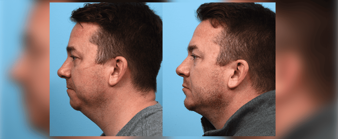Adult man overbite before and after mewing