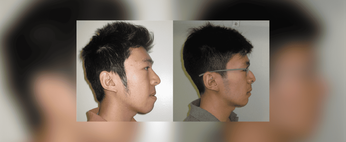 Asian man underbite before and after mewing