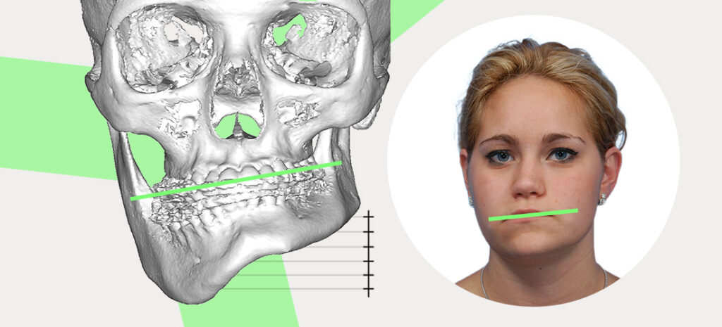 Asymmetrical Jaw Chin Causes And How To Fix It Naturally Mewing Coach   Asymmetrical Jaw 1024x465 