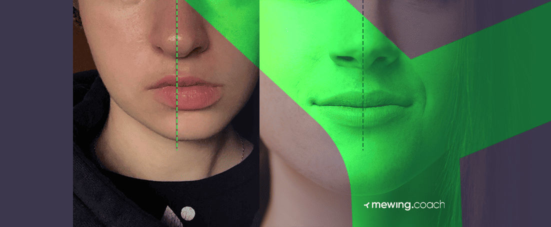 Asymmetrical Jaw Chin Causes And How To Fix It Naturally Mewing Coach   Asymmetrical Jaw And Chin Before And After Mewing 