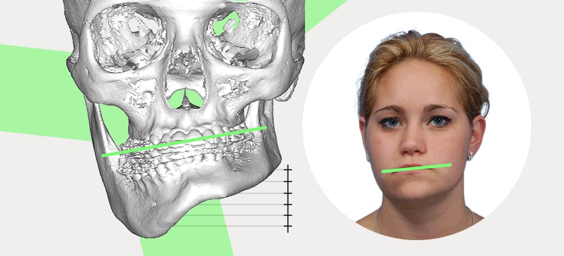 Asymmetrical Jaw Chin Causes And How To Fix It Naturally 46 OFF