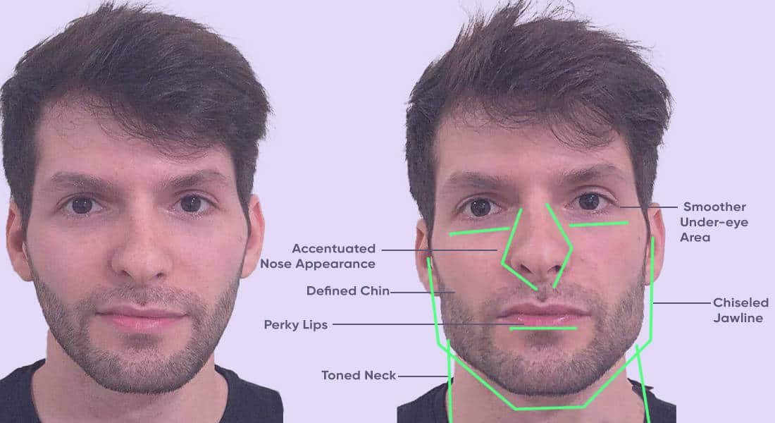 Better jawline and overall face structure after jaw exercises