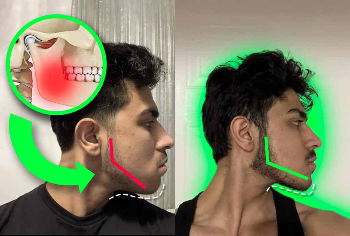 Better jawline before and after transformation