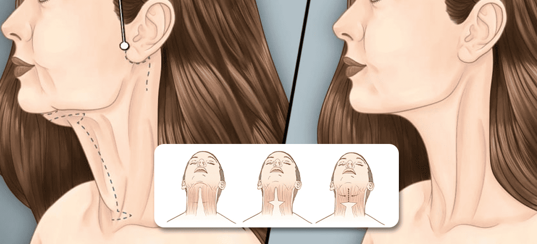 Chin lifts exercise for a wider jaw