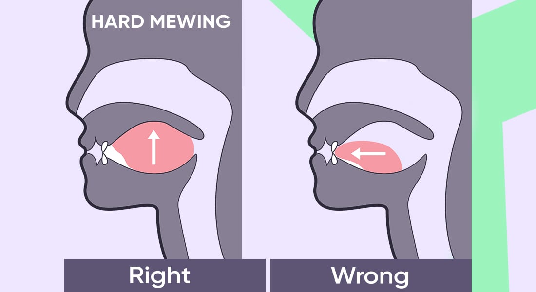 Difference between hard mewing and mewing being hard