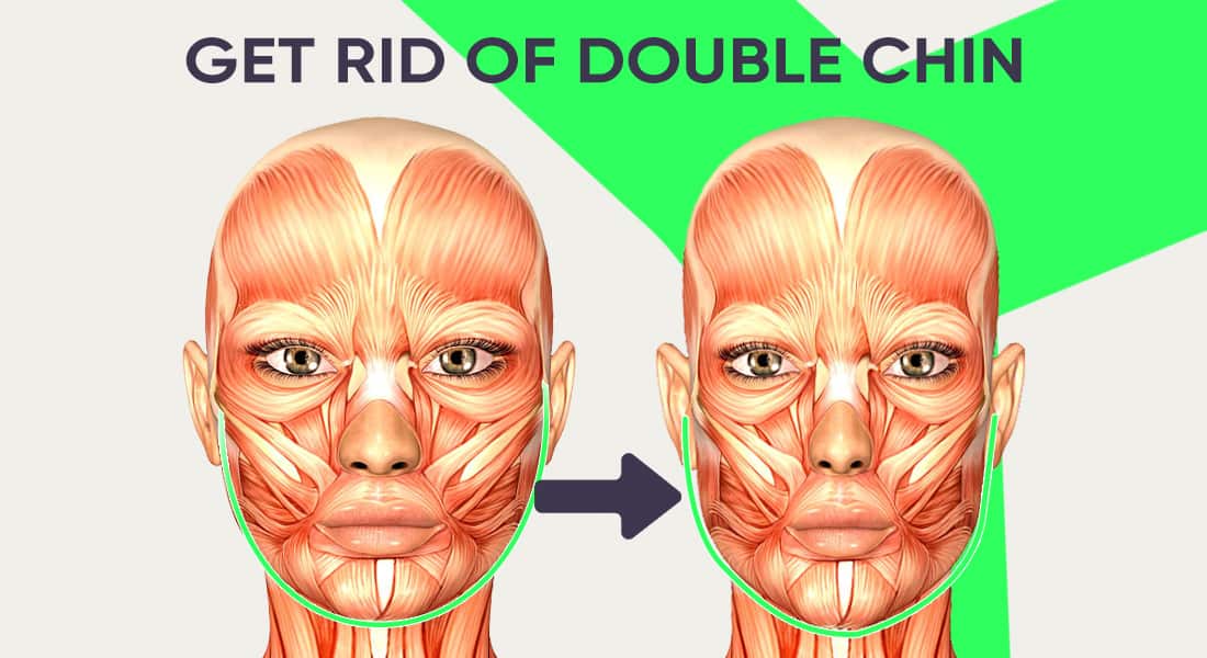 Double chin before and after mewing