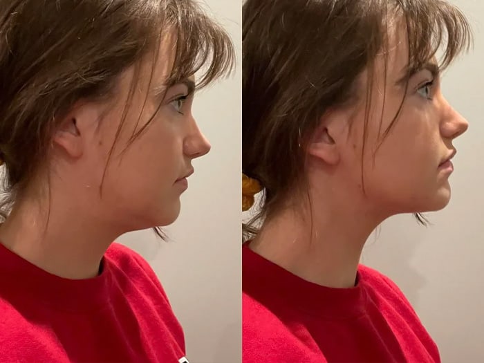 Surgery or mewing exercises. Result of a jawline reshape. Stock