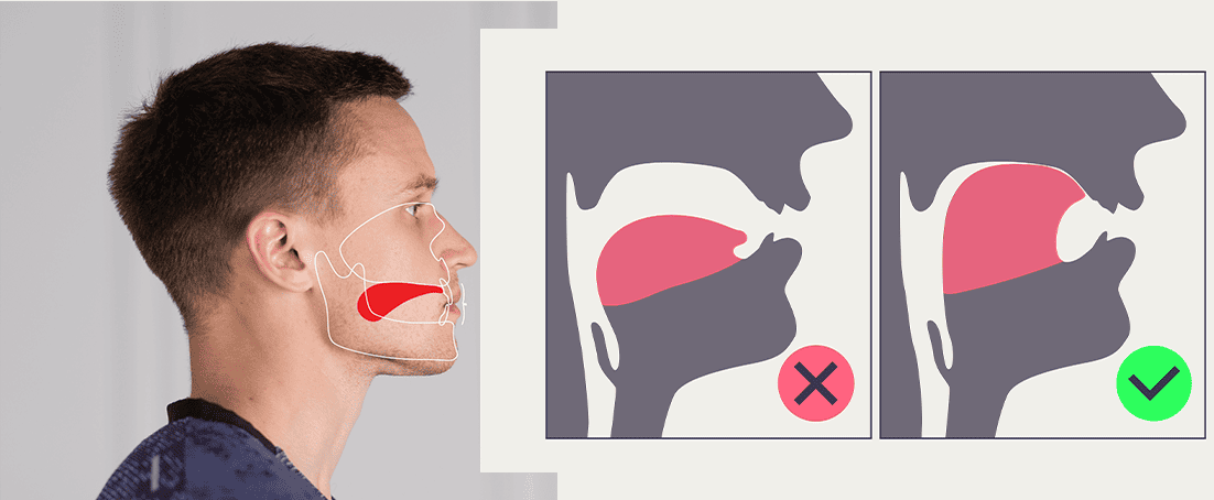 Example of correct and incorrect tongue posture