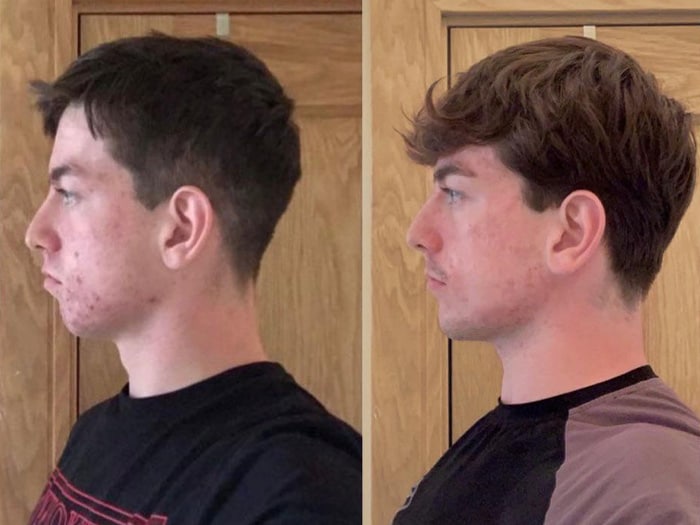 Face and jawline before and after mewing