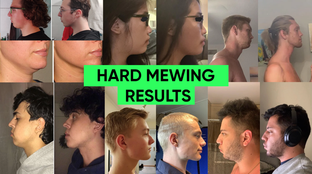 10-tips-on-how-to-get-a-wider-jaw-mewing-coach