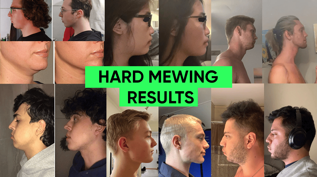 Hard mewing results