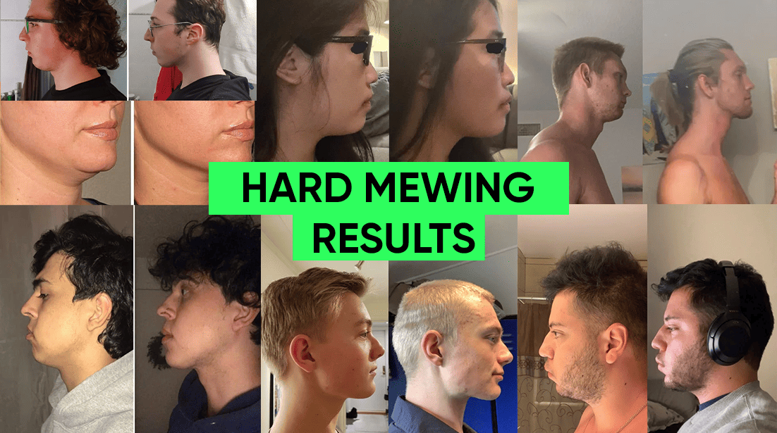 Mewing for Jawline: The Complete Guide for Exercises