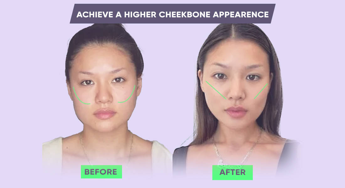 Higher cheekbone appearance before and after mewing