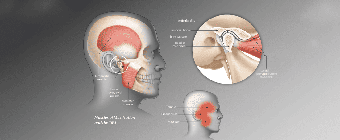 Image explaining what TMJ is