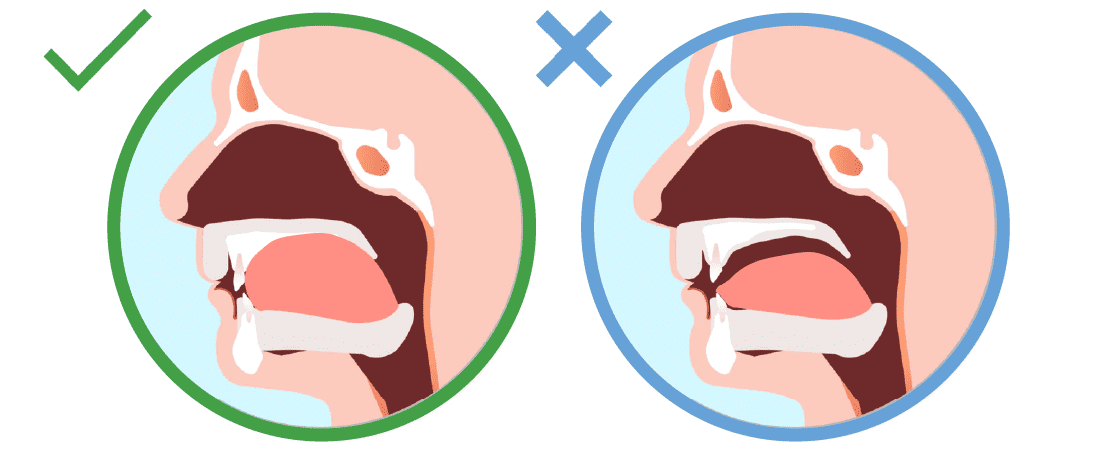 Incorrect tongue posture