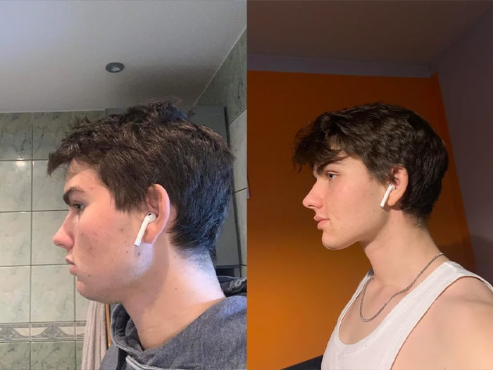 Mewing Exercises. Result of a Jawline Reshape Stock Photo - Image
