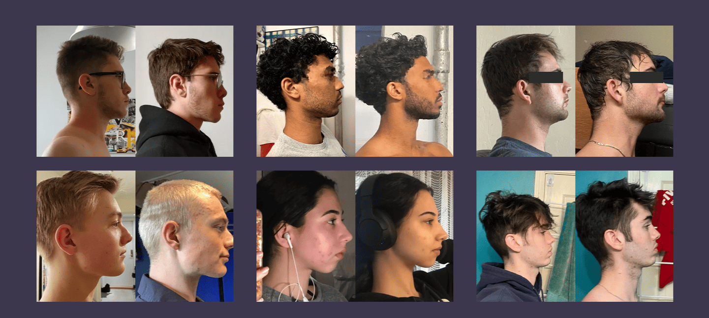 Jawline exercises before and after
