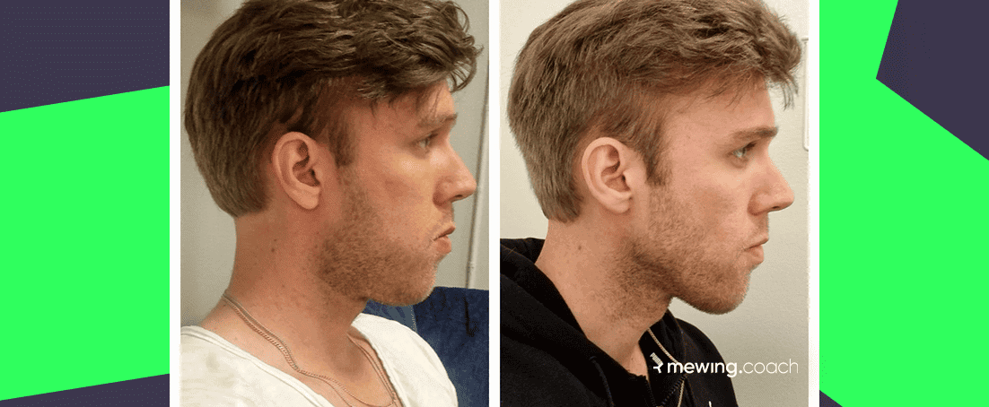Jawline growth of a male before and after exercises