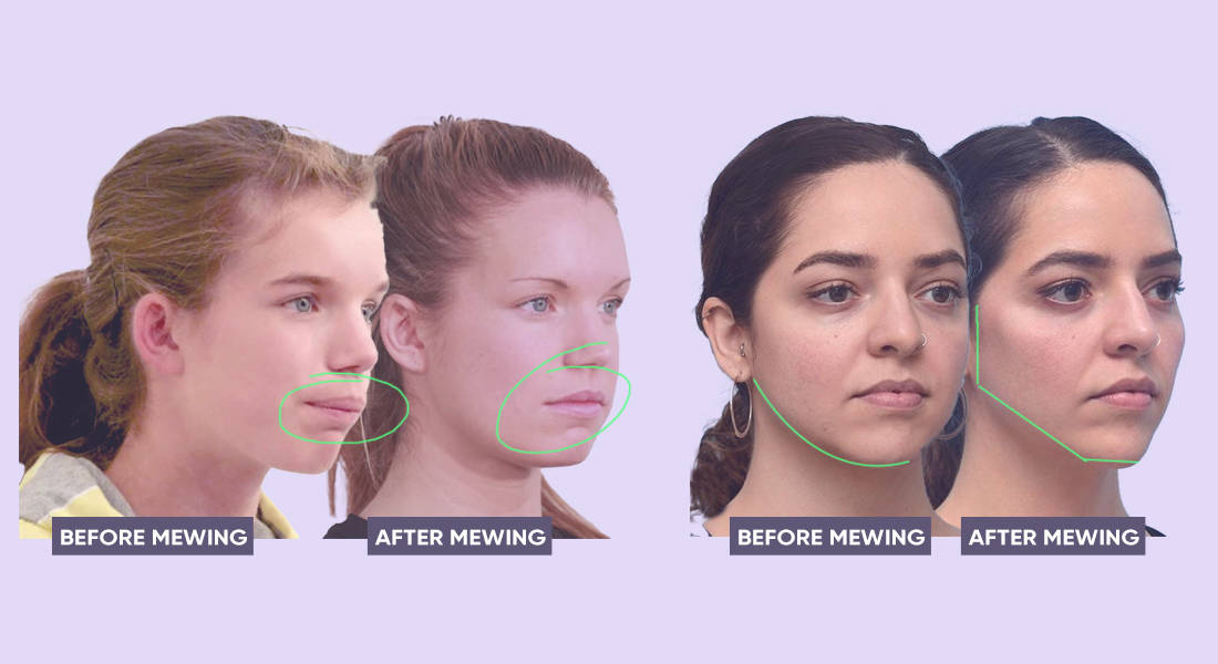Does Mewing Work To Sculpt Your Jawline? Here's What To Know