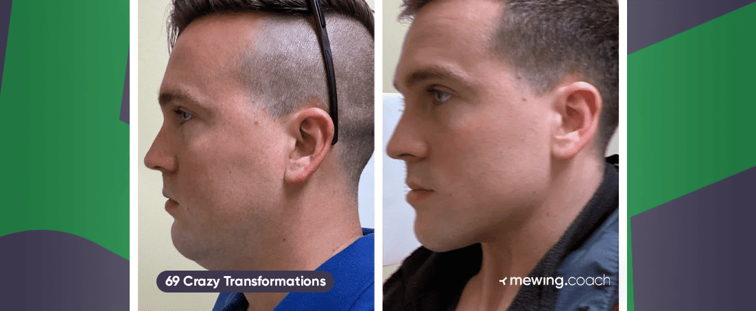 Mewing Before & After Results: 70+ Crazy Transformations