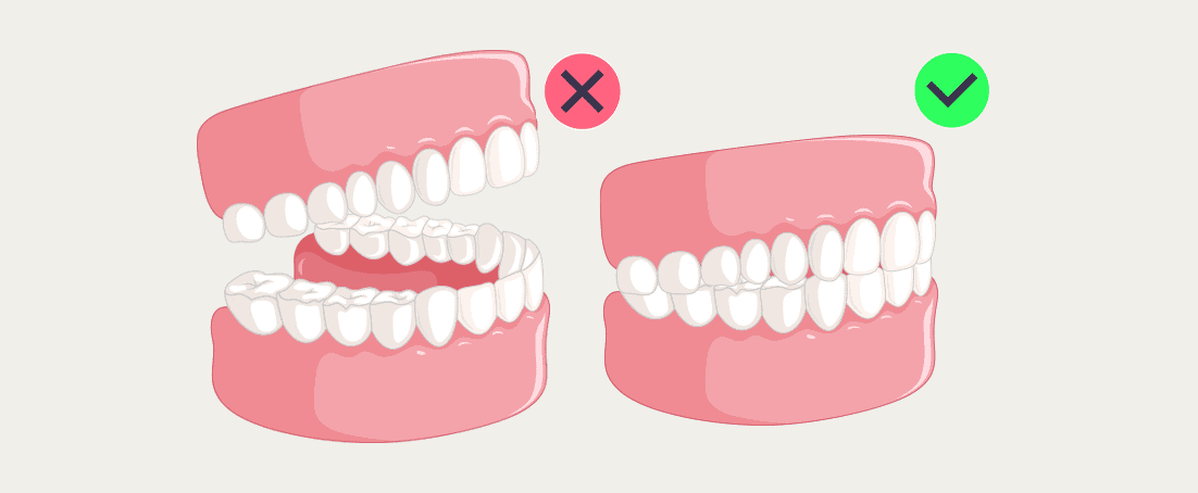 Mewing: correct teeth posture vs incorrect