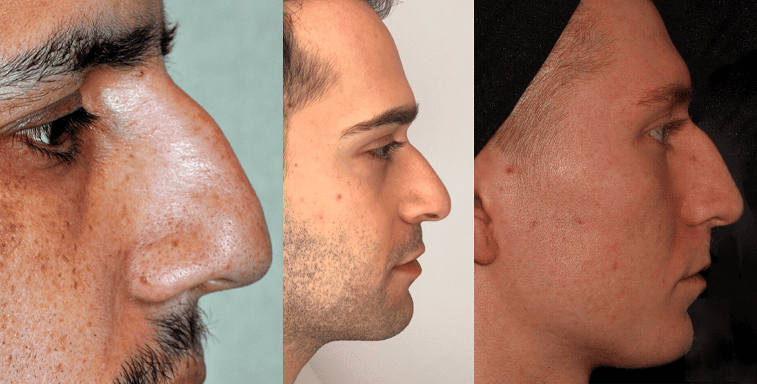 Facial Exercises To Change The Shape Of Your Nose 