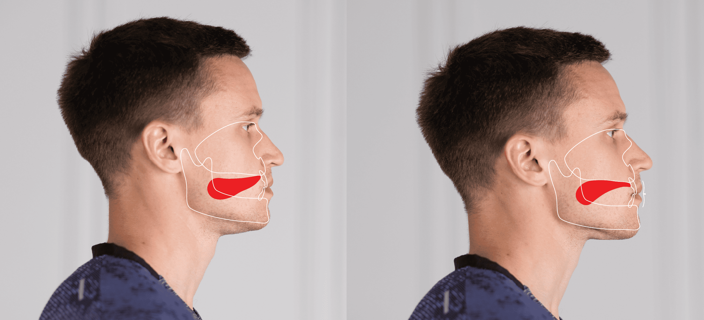 Conheça o mewing, exercício facial que promete reduzir a papada e