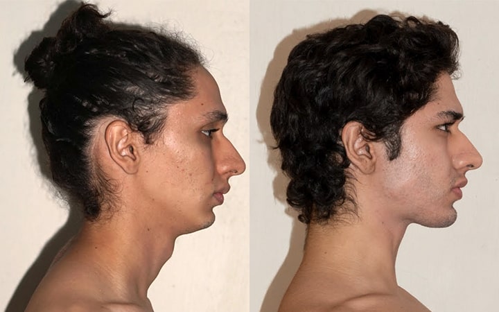 Receding chin before and after mewing