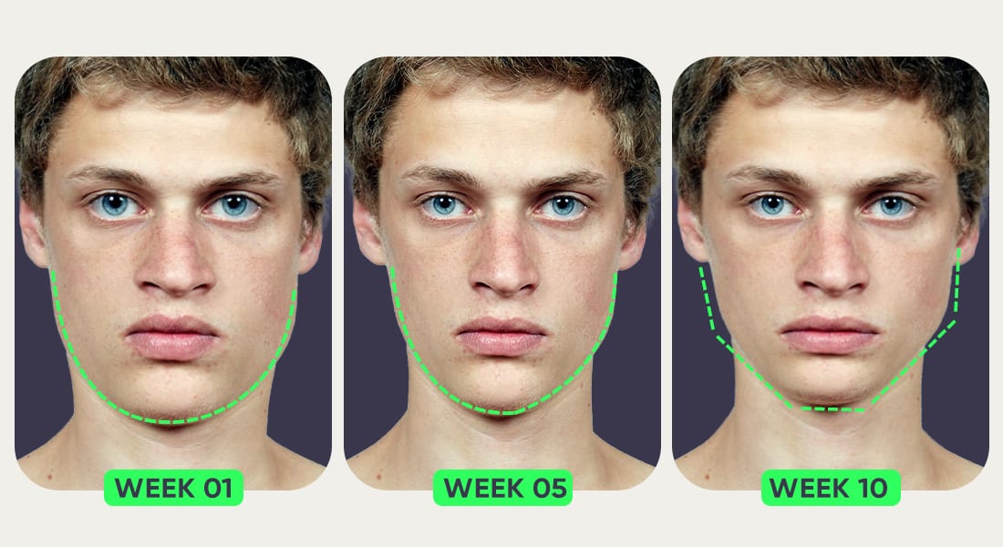 Mewing results after one, five and ten weeks of regular mewing