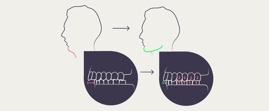 Jaw and teeth posture diagram while mewing