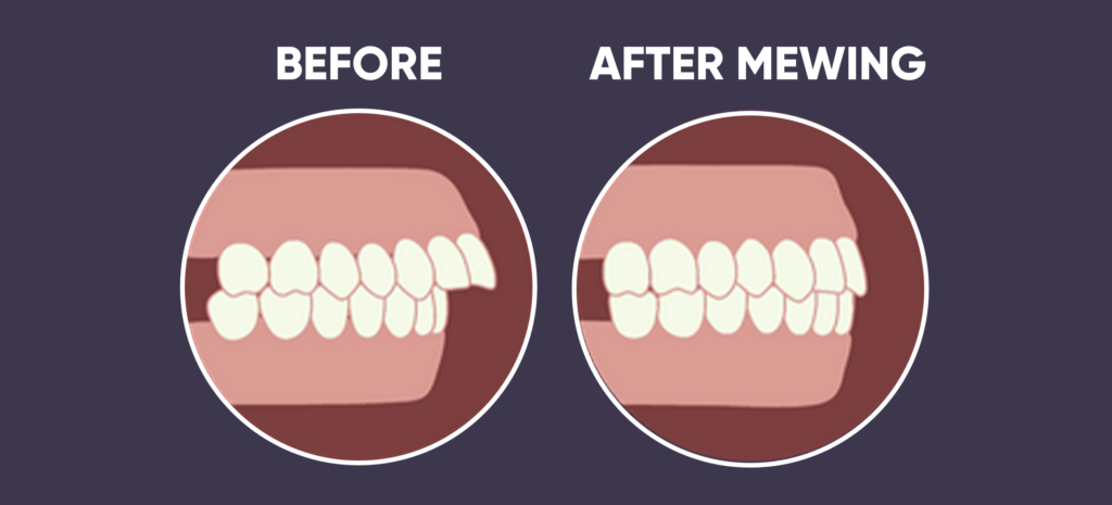 How Can Mewing Fix Overbite Mewing Coach