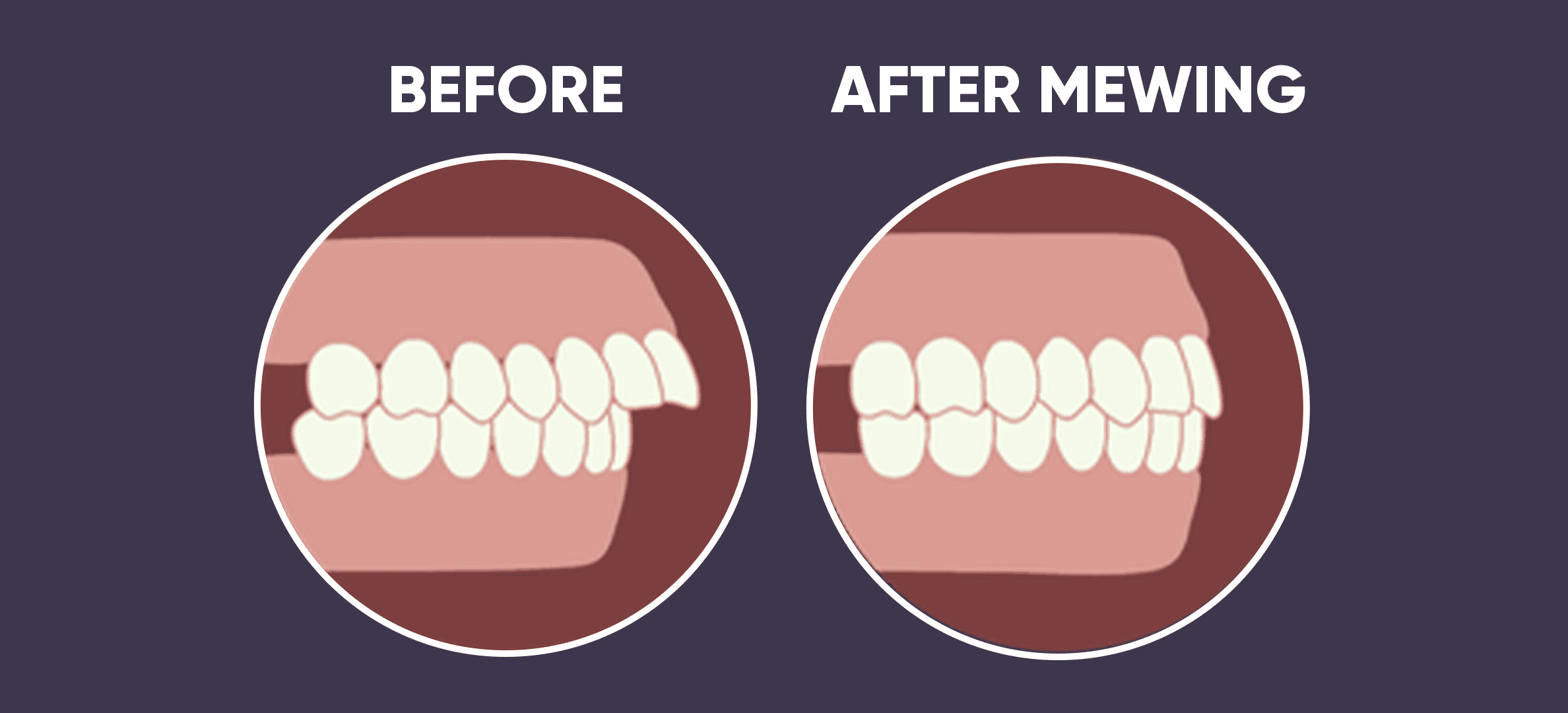 Overbite before and after mewing