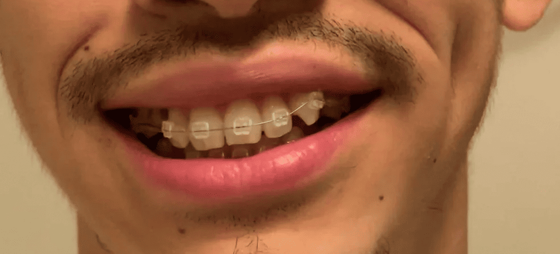 Person with braces