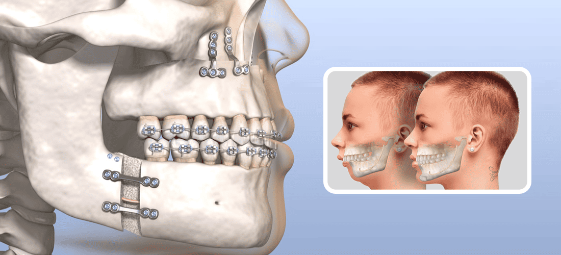 Surgery for a wider jaw