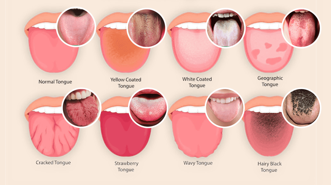 Tongue color chart