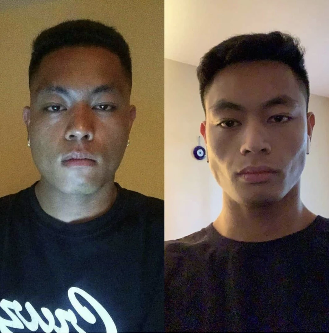 Young adult Asian man before and after transformation to a sharper jawline