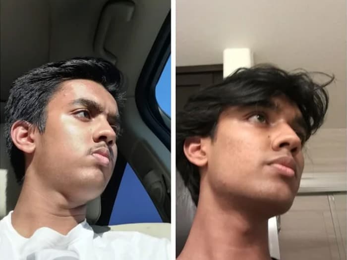 Male Double Chin Results Before & After