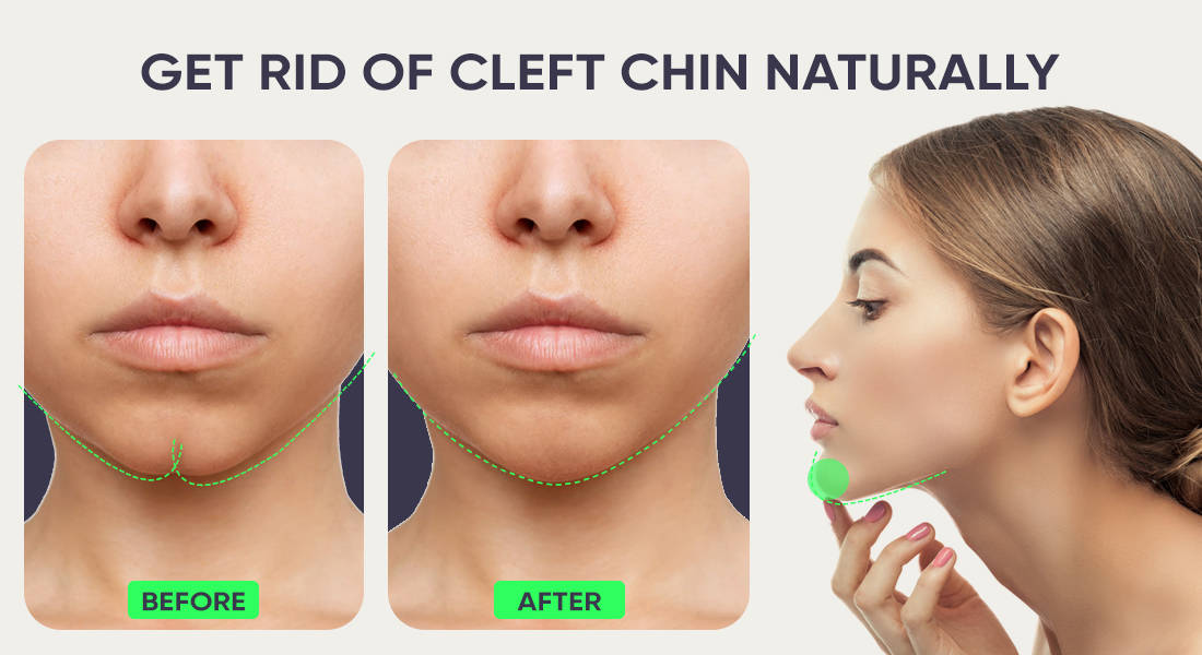 Cleft chin before and after natural face exercises