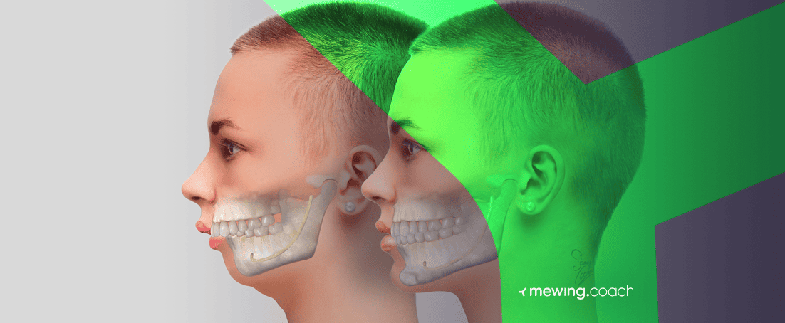 Double Chin Overbite What They Have In Common Mewing coach