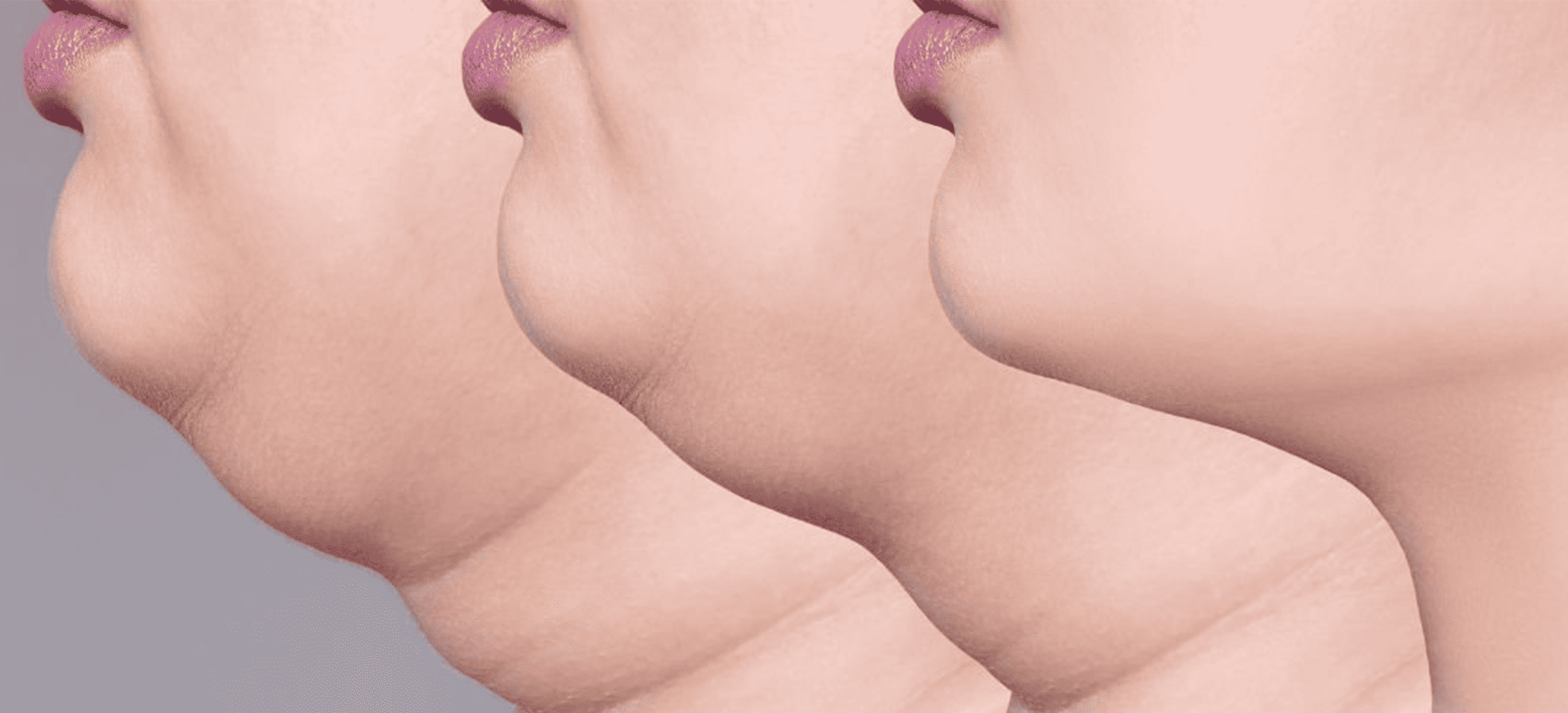 Facial structure effect on a double chin