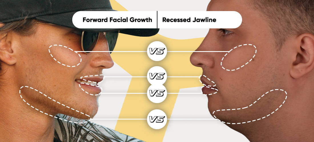 Forward facial growth vs recessed jawline