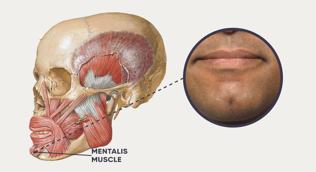 Mentalis muscle displayed on human skull and face