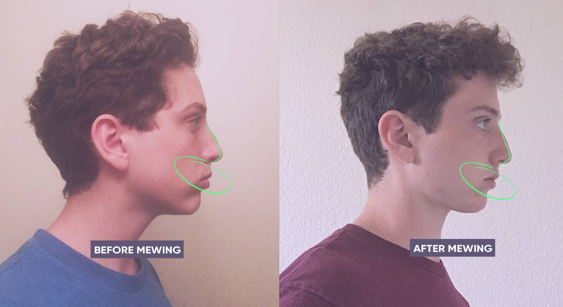 Pointy chin before and after mewing
