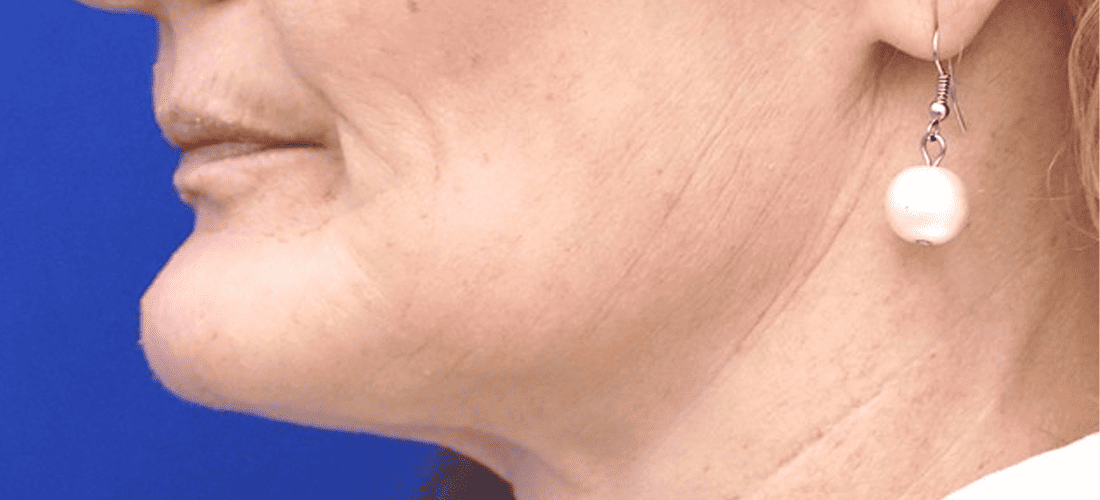 Protruding chin