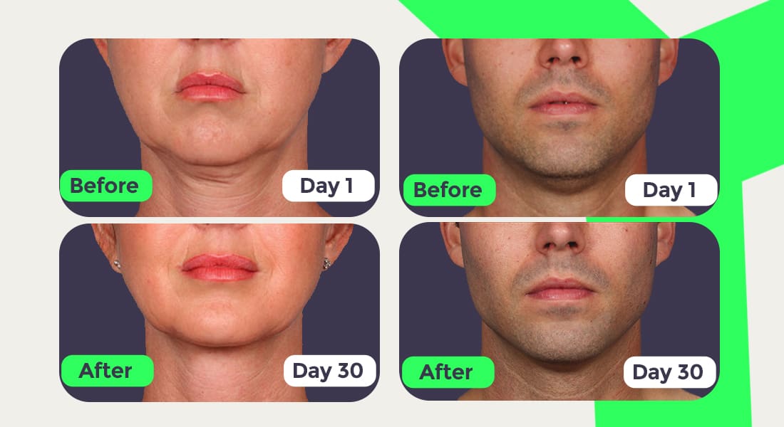 Skin tightening with face exercises before and after results