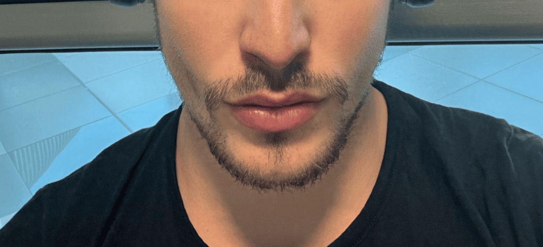 10 Different Types Shapes Of Chin A Comprehensive List Mewing coach