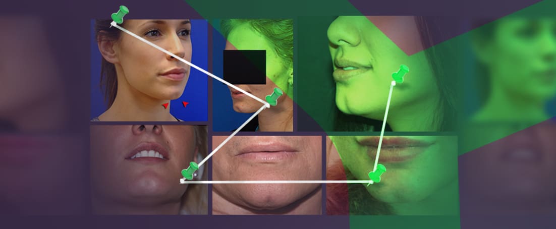 Various types of cleft chins