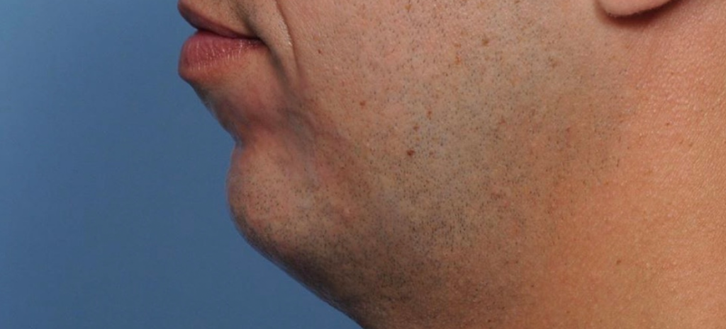 10 Different Types & Shapes Of Chin: A Comprehensive List | Mewing.coach