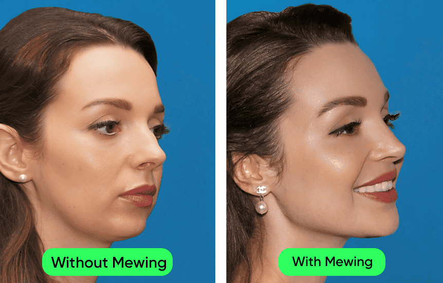 Woman cheekbones before and after mewing